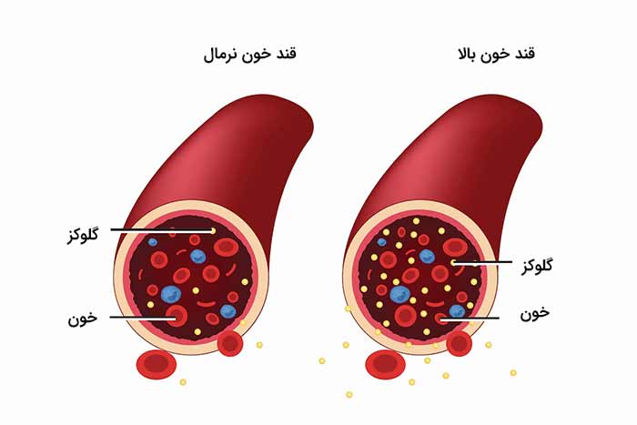 قند خون بالا