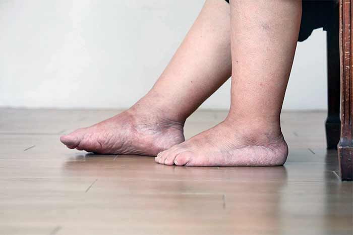 تورم در پاها