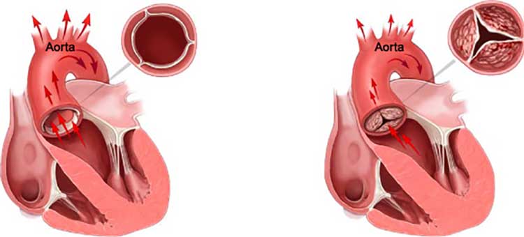 بیماری قلبی تنگی آئورت