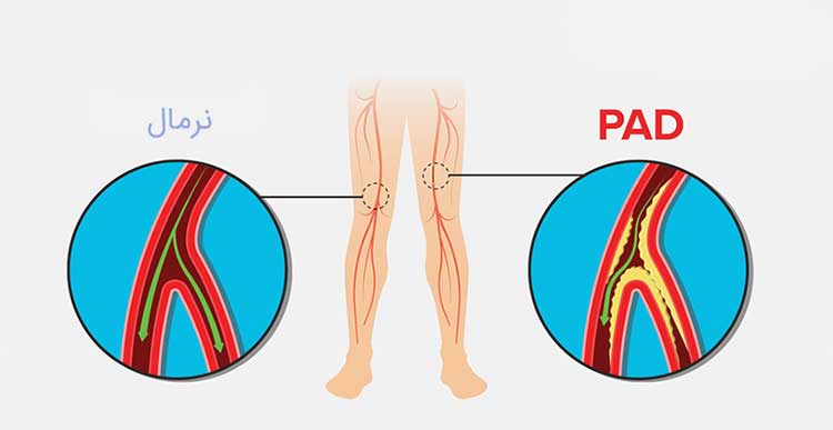 بیماری قلبی بیماری عروق محیطی