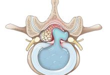 بهترین قرص غضروف ساز ایرانی و خارجی برای دیسک کمر