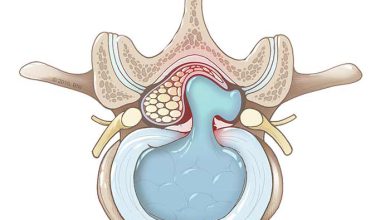 دیسک کمر بهترین قرص غضروف ساز ایرانی و خارجی برای دیسک کمر